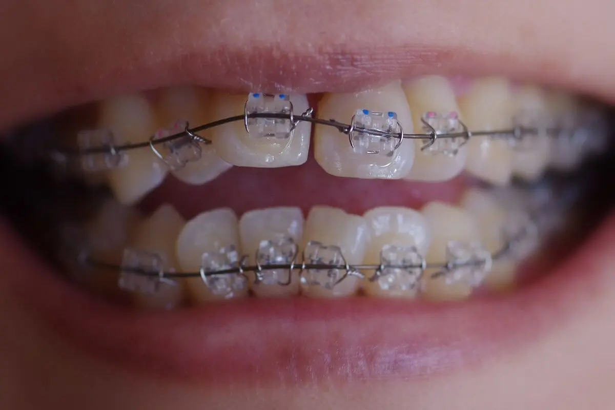 Close-up of a mouth with clear brackets and a thin wire bonded to the teeth