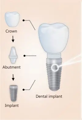 Diagram of the three parts of a dental implant: the crown on top, the abutment connector in the middle, and the threaded titanium implant that sits in the jawbone.