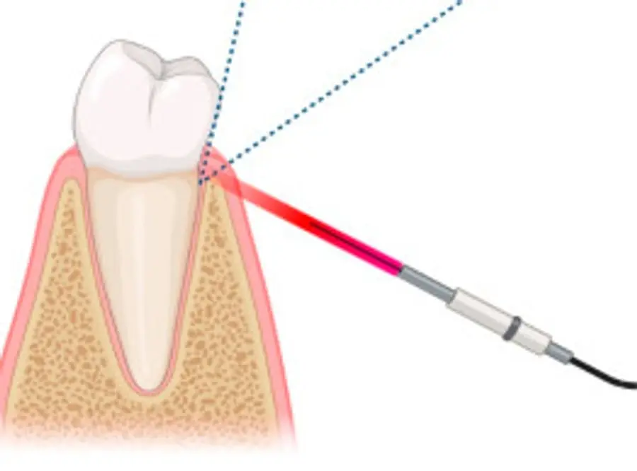 Drawing of a tooth in its gum and bone with a laser fibre aimed along the gum edge and dotted lines showing the beam spread