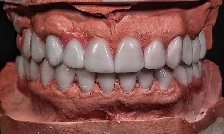 Full set of upper and lower teeth modelled in wax on grey plaster casts of the jaws