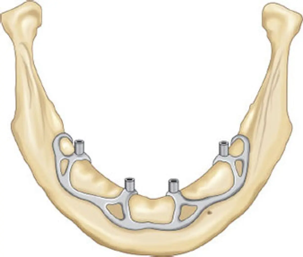 A custom metal framework resting on top of the lower jawbone, with four small posts projecting upward to hold a denture.