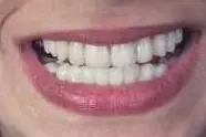 Gauri's teeth after treatment
