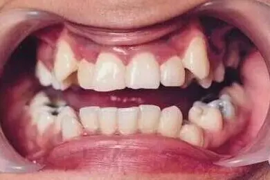 Gauri's teeth before treatment