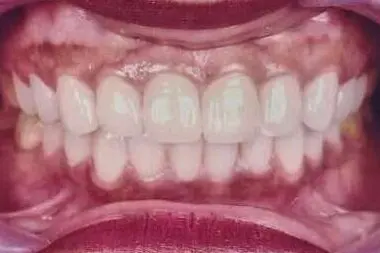The patient's teeth after treatment