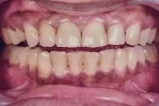 The patient's teeth before treatment