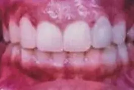 The patient's teeth after treatment