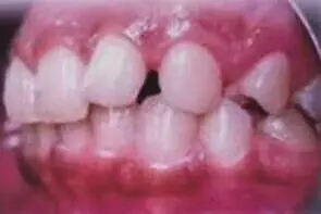 The patient's teeth before treatment