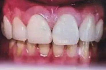 Sanjay's teeth after treatment
