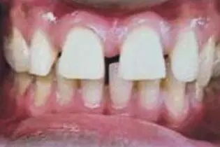 Sanjay's teeth before treatment