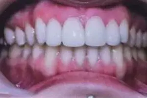 Jemma's teeth after treatment