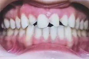 Jemma's teeth before treatment