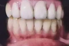 Eswari's teeth after treatment