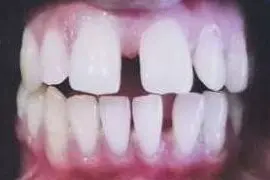 Eswari's teeth before treatment
