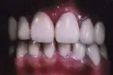 Papori's teeth after treatment