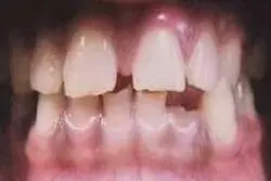 Papori's teeth before treatment