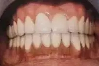 Akhilesh's teeth after treatment