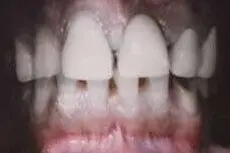Akhilesh's teeth before treatment