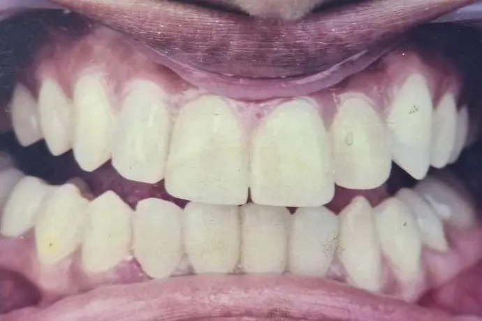 Gail's teeth after treatment