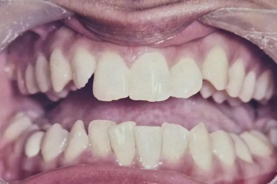 Gail's teeth before treatment
