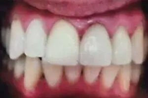 Dirk's teeth after treatment