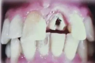Dirk's teeth before treatment