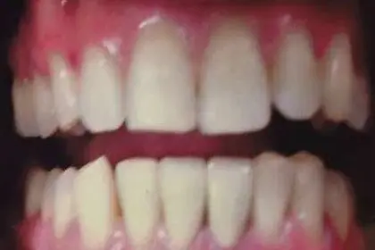 Dhiren's teeth after treatment