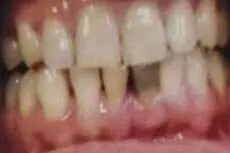 Dhiren's teeth before treatment