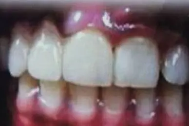 Mrunal's teeth after treatment