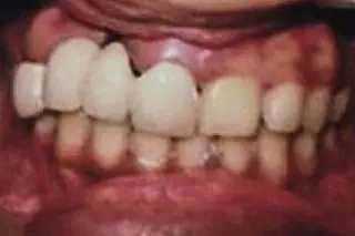Mrunal's teeth before treatment