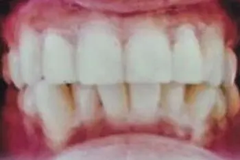 The patient's teeth after treatment