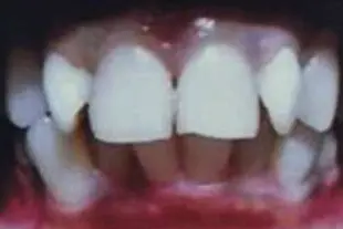 The patient's teeth before treatment