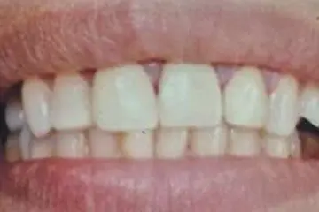 Faujiya's teeth after treatment