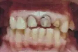 Faujiya's teeth before treatment