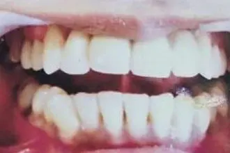 Jyoti's teeth after treatment