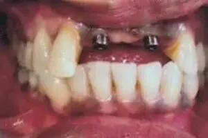 Jyoti's teeth before treatment