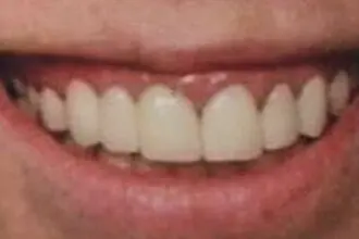 The patient's teeth after treatment