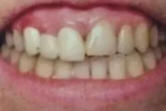 The patient's teeth before treatment