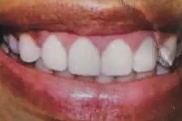 The patient's teeth after treatment