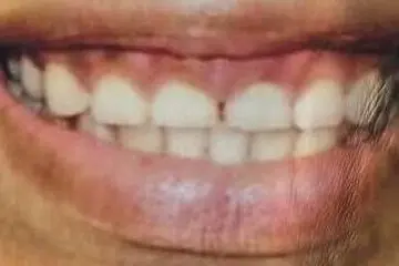 The patient's teeth before treatment