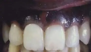 Dhawal's teeth after treatment