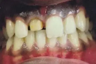 Dhawal's teeth before treatment