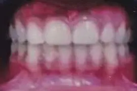 Azan's teeth after treatment
