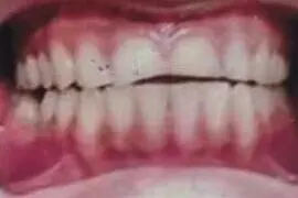 Azan's teeth before treatment