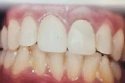 The patient's teeth after treatment