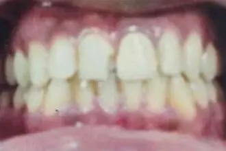 The patient's teeth before treatment