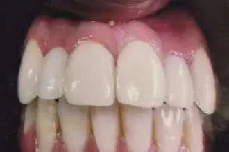 Akshay's teeth after treatment