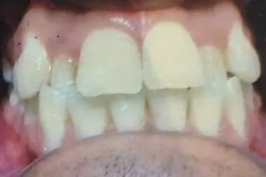 Akshay's teeth before treatment