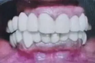 Sangita's teeth after treatment