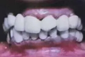 Sangita's teeth before treatment