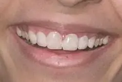 The patient's teeth after treatment